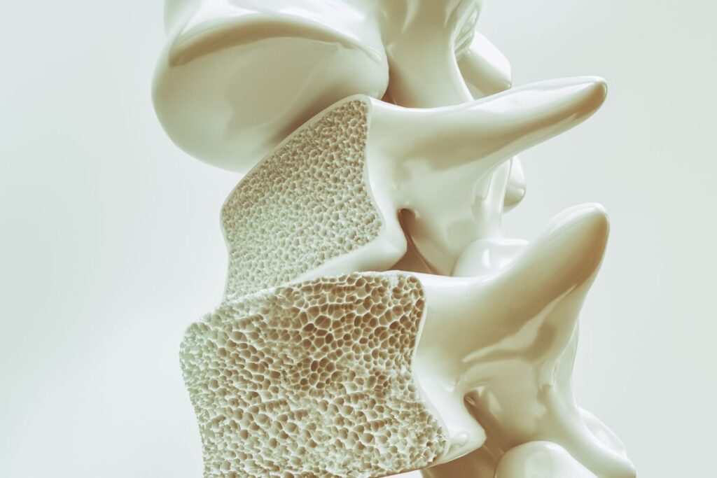 osteoporose-dra-mariana-ataide-medica-endocrinologista-sao-paulo